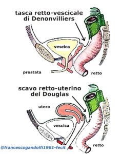 liquido nel douglas e endometriosi Cos'è l'endometriosi? main image 0